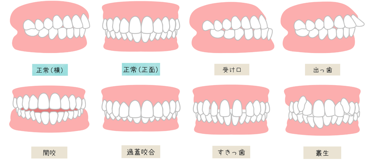 歯並びの種類別