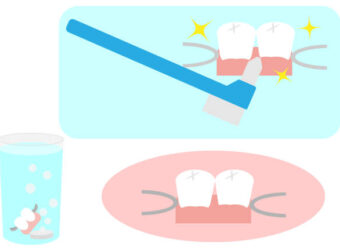 部分入れ歯の除菌清掃